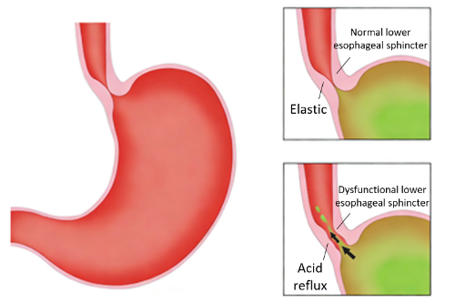 تبسيط تشخيص الارتجاع المعدي المريئي: من التنظير الداخلي إلى اختبارات اللعاب غير الجراحية